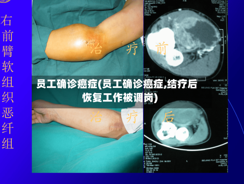 员工确诊癌症(员工确诊癌症,结疗后恢复工作被调岗)