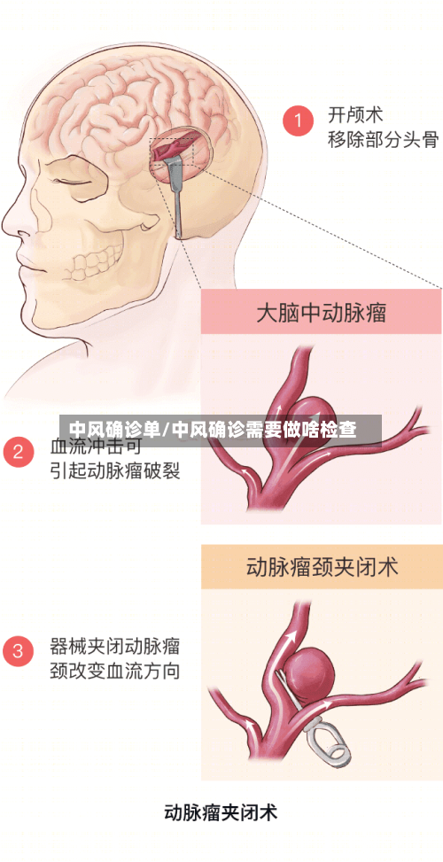 中风确诊单/中风确诊需要做啥检查