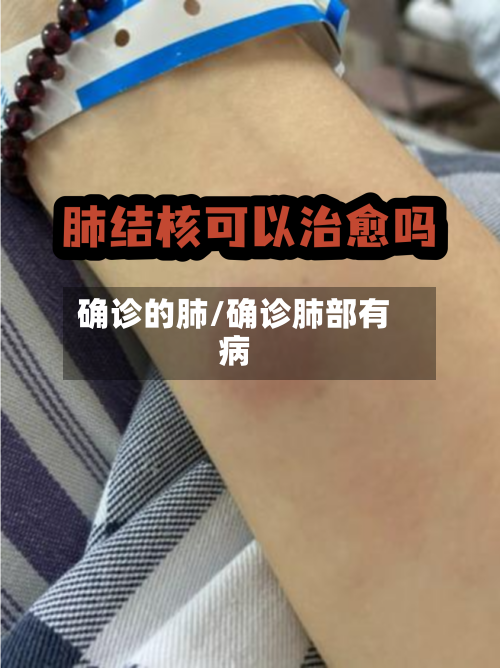 确诊的肺/确诊肺部有病