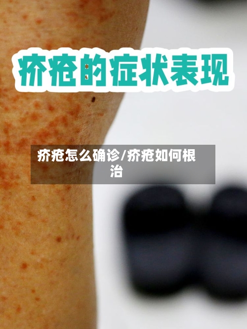 疥疮怎么确诊/疥疮如何根治