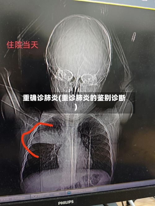 重确诊肺炎(重诊肺炎的鉴别诊断)