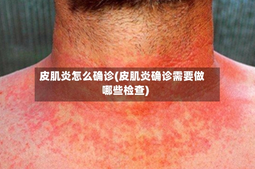 皮肌炎怎么确诊(皮肌炎确诊需要做哪些检查)