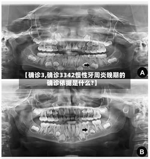 【确诊3,确诊3342慢性牙周炎晚期的确诊依据是什么?】